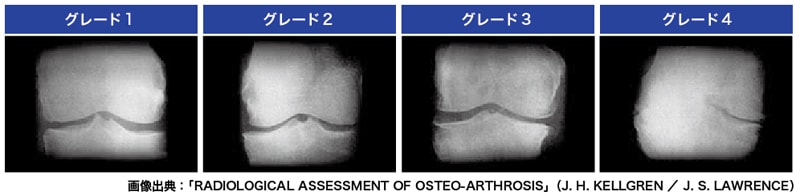 変形性膝関節症の進行度を示すグレード