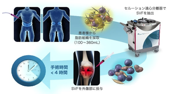 間質血管細胞群SVFによる治療