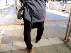 変形性膝関節症によるO脚変形