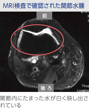 膝の関節水腫のMRI