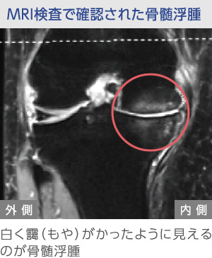 MRI検査で確認された関節浮腫