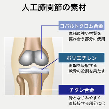 人工膝関節に用いられる素材