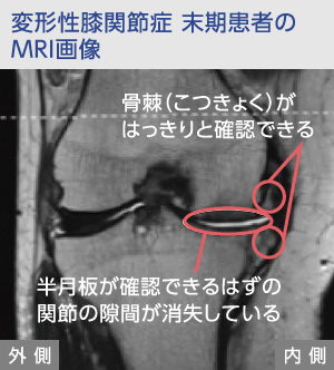 変形性膝関節症末期のMRI