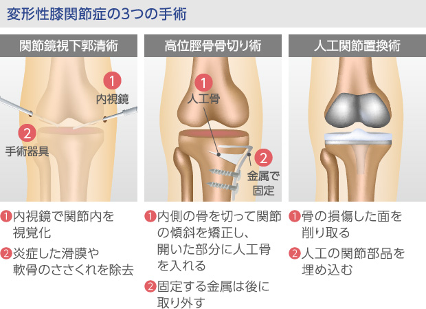 変形性膝関節症の３つの手術