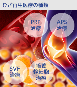 変形性膝関節症に対する再生医療の種類