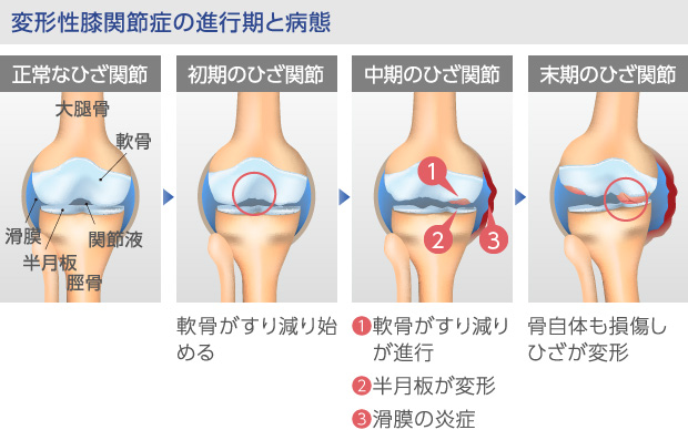 変形性膝関節症の病態変化