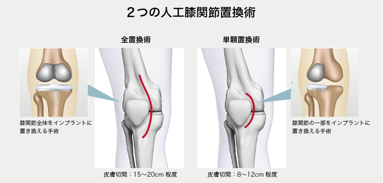 人工膝関節置換術の術式