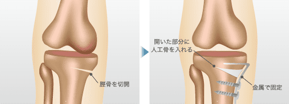 高位脛骨骨切り術