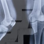 変形性膝関節症の重症度（グレード）はどう決まるか