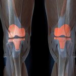 膝の人工関節とは？手術の決断前に知りたい重要事項