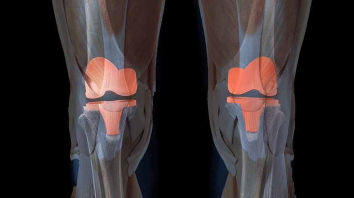 膝の人工関節置換術