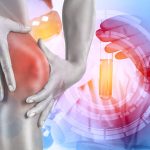 変形性膝関節症の最新治療が、日々進歩しています