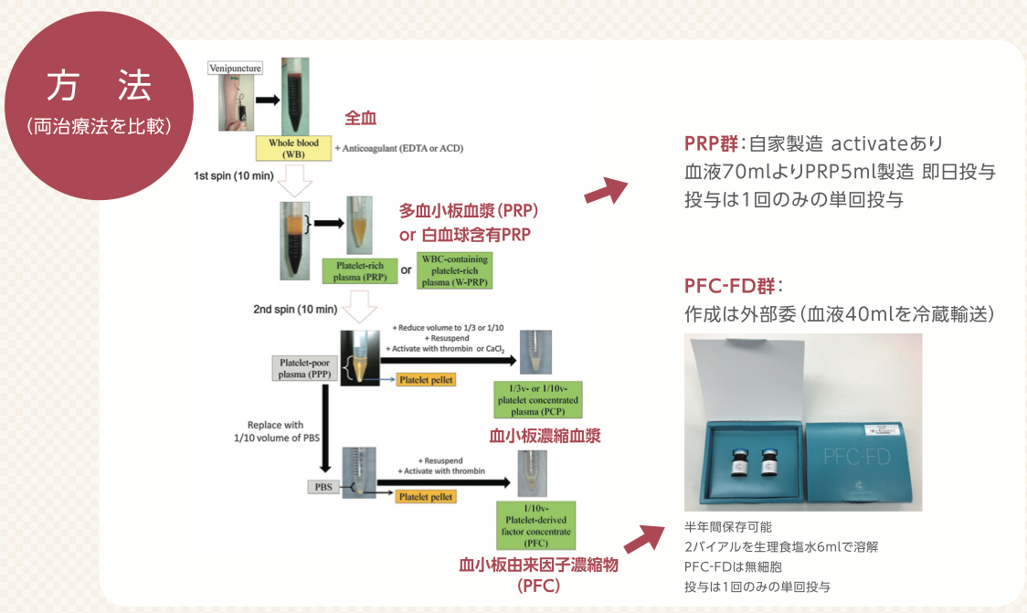 PRP治療とPRP-FD注射の工程の違い