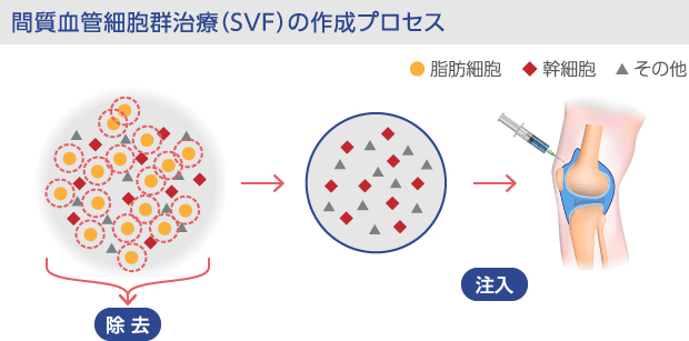 間質血管細胞群（SVF）の注入プロセス