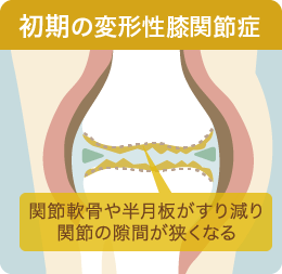 初期の変形性膝関節症
