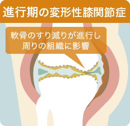 進行期の変形性膝関節症