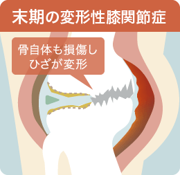 末期の変形性膝関節症