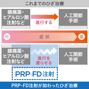 人工関節の手術を遅らせる イメージ