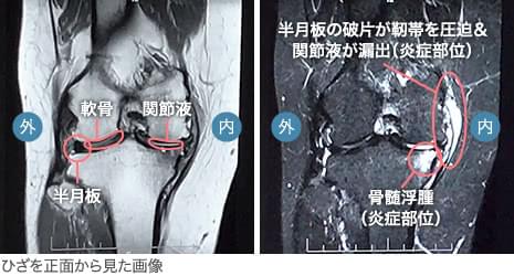 60代・女性／骨挫傷／骨髄浮腫