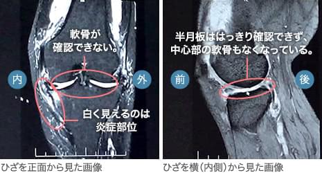 60代前半・女性／骨挫傷／骨髄浮腫