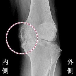 関節の隙間がなくなった変形性膝関節症末期のレントゲン写真