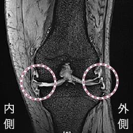 骨棘や半月板の変性、関節水腫などが認めらえる変形性膝関節症のMRI画像