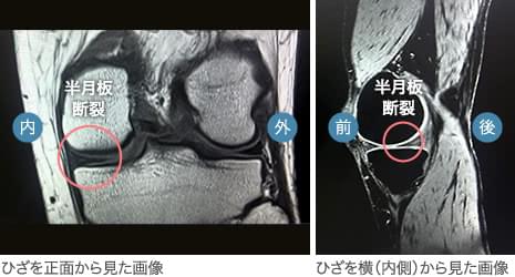 半月板損傷のMRI画像｜50代男性