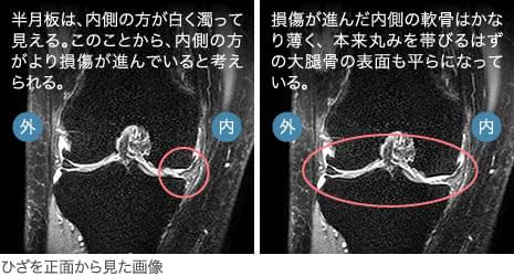 50代前半・女性／変形性膝関節症